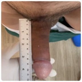 before-after photo penile-implant-surgery