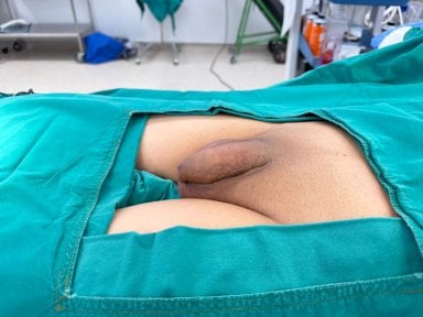 before-after photo penile-implant-surgery