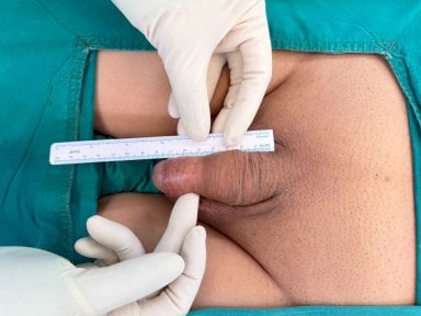 before-after photo penile-implant-surgery