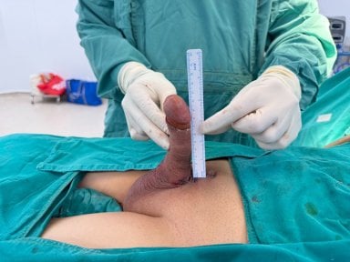 before-after photo penile-implant-surgery