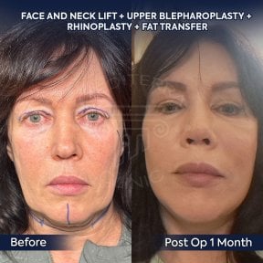 before-after photo deep-plane-facelift