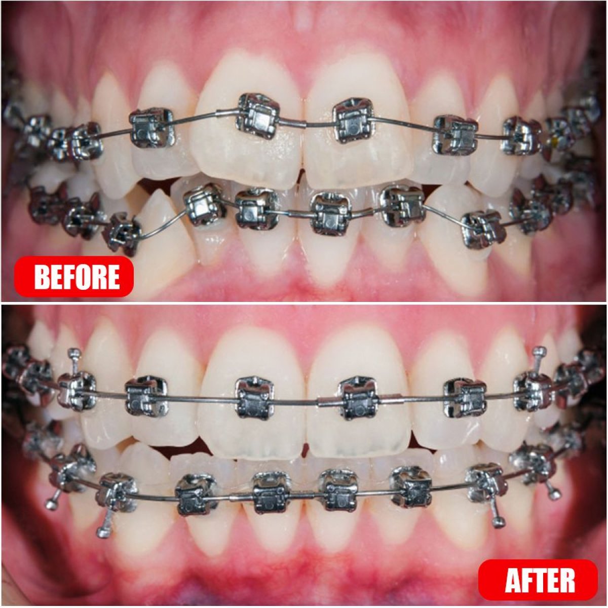 Resultados antes y después de ortodoncia en SAIGON CENTER DENTAL CLINIC, mejora de alineación dental