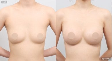 Before and after breast augmentation results at AB Plastic Surgery, enhanced breast volume