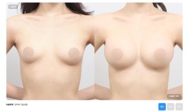 Before and after breast reduction results at AB Plastic Surgery – improved breast contour