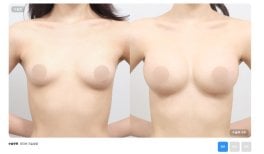 Before and after breast reduction results at AB Plastic Surgery – improved breast contour