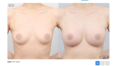 Before and after breast reduction results at AB Plastic Surgery, improved breast contour