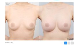 Before and after breast reduction results at AB Plastic Surgery, improved breast contour