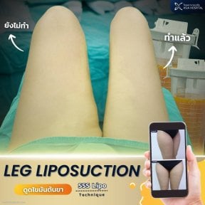 Résultats avant/après liposuccion des jambes à Asia Cosmetic Hospital, amélioration des cuisses