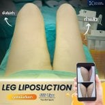 Résultats avant/après liposuccion des jambes à Asia Cosmetic Hospital, amélioration des cuisses
