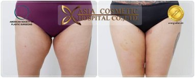 Résultats avant/après lifting complet du corps à Asia Cosmetic Hospital, cuisses affinées