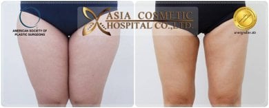 Résultats avant/après lifting complet du corps à Asia Cosmetic Hospital, cuisses affinées