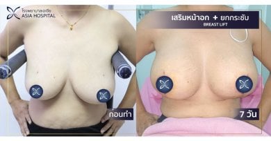 Résultats avant et après lifting mammaire à Asia Cosmetic Hospital, contour amélioré