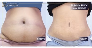 Résultats avant/après abdominoplastie à Asia Cosmetic Hospital – ventre plat et ferme