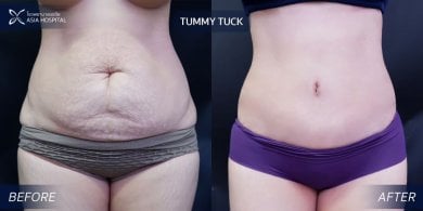 Résultats avant/après abdominoplastie à Asia Cosmetic Hospital – ventre plat et ferme