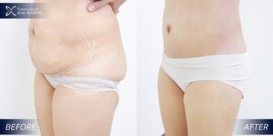Résultat lifting corporel complet avant/après à Asia Cosmetic Hospital, ventre raffermi