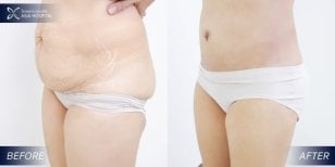 Résultat lifting corporel complet avant/après à Asia Cosmetic Hospital, ventre raffermi
