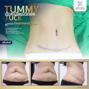 Résultats avant/après abdominoplastie à Asia Cosmetic Hospital, cicatrice discrète