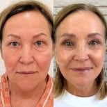 Before and after blepharoplasty results at View Plastic Surgery Hospital, eyelid correction