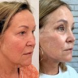 Before and after blepharoplasty results at View Plastic Surgery Hospital, eyelid correction