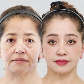 Before and after blepharoplasty results at View Plastic Surgery Hospital, eyelid correction