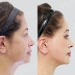 Before and after facelift results at View Plastic Surgery Hospital, visible facial rejuvenation