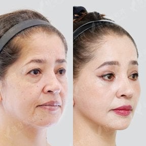 Before and after blepharoplasty results at View Plastic Surgery Hospital, eyelid correction