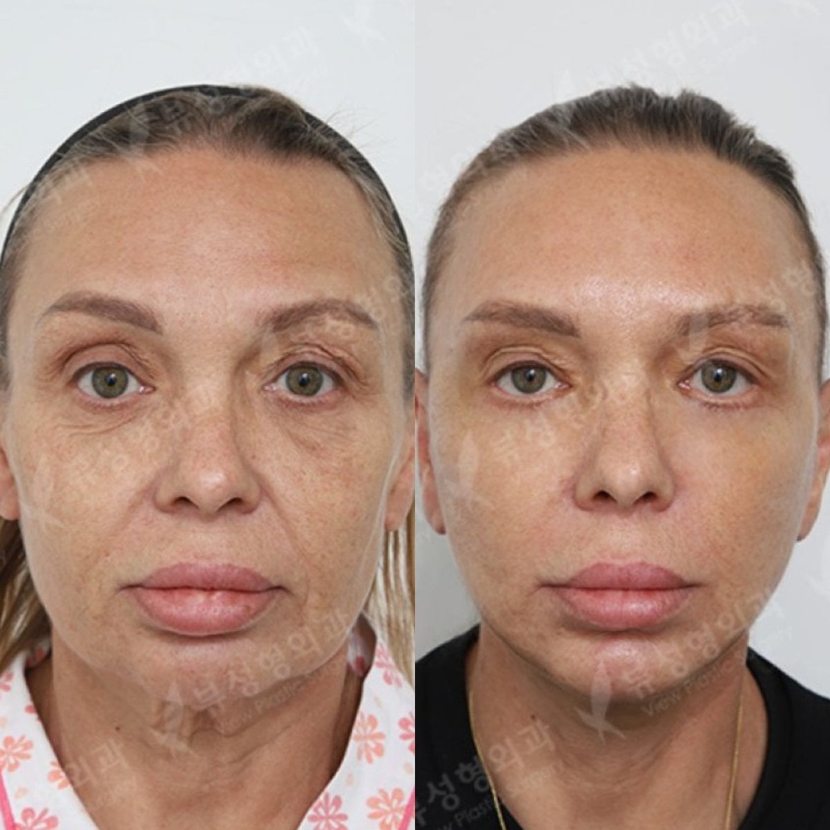 نتائج رأب الجفن قبل وبعد في View Plastic Surgery Hospital، تصحيح الجفون