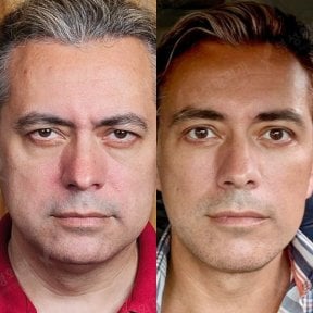 Before and after blepharoplasty results at View Plastic Surgery Hospital, eyelid correction