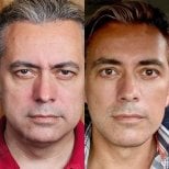 Before and after blepharoplasty results at View Plastic Surgery Hospital, eyelid correction