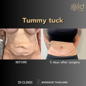before-after photo abdominoplastika