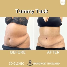 before-after photo abdominoplastika