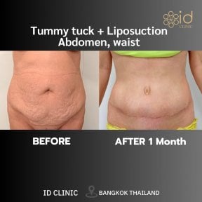 before-after photo abdominoplastika