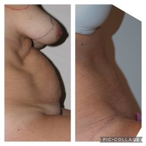 before-after photo 360-liposuction