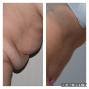 before-after photo 360-liposuction