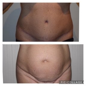 before-after photo 360-liposuction