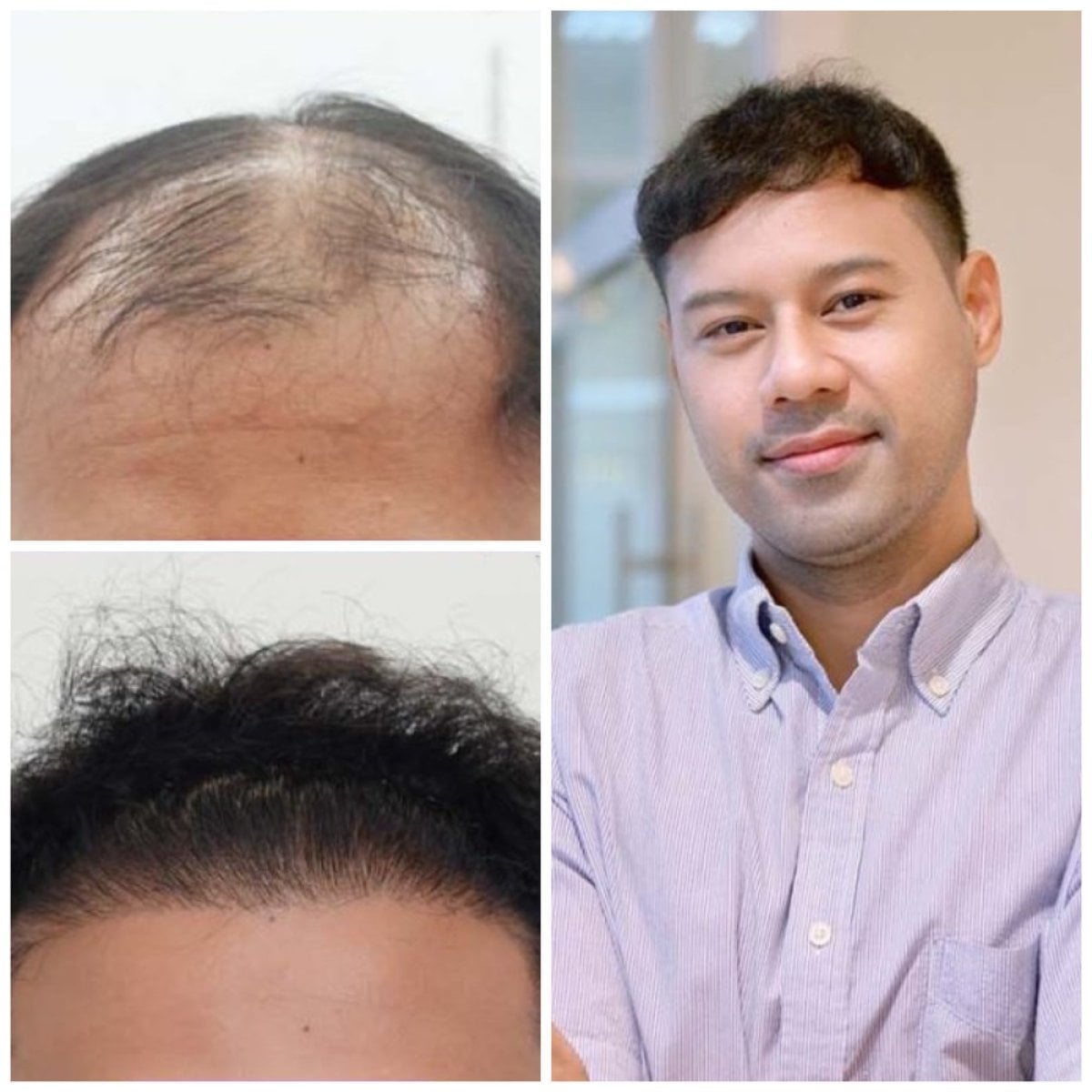 Resultados de trasplante capilar antes y después en Department of Skin & Surgery - NAVAMIN9 HOSPITAL