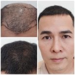 نتائج زراعة الشعر قبل وبعد في قسم الجلدية والجراحة - مستشفى نافامين9