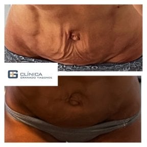 before-after photo 360-liposuction