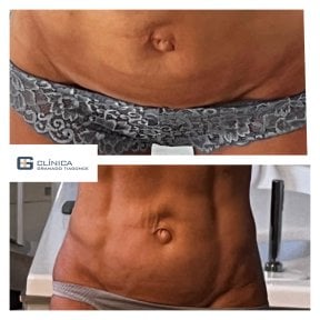 before-after photo 360-liposuction