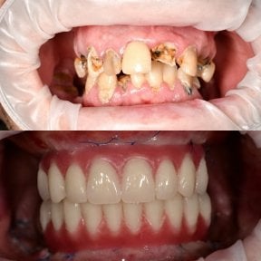 before-after photo all-on-6-dental-implants