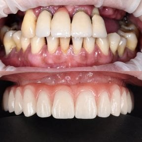 before-after photo all-on-6-dental-implants