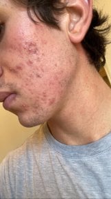 before-after photo top-surgery