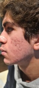 before-after photo top-surgery