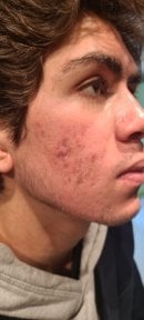 before-after photo top-surgery