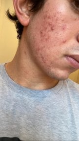 before-after photo top-surgery