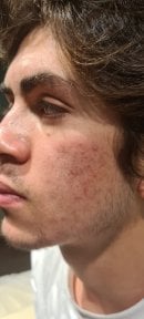 before-after photo top-surgery