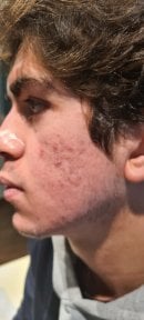 before-after photo top-surgery