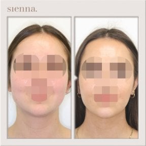 before-after photo liposakciya-360