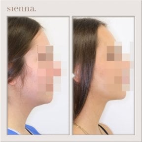 before-after photo liposakciya-360