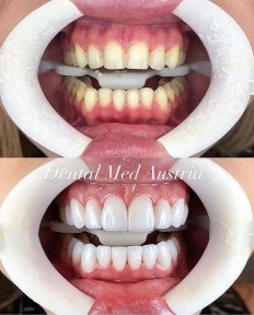 До и после установки виниров Emax в Dental Med Austria & Elixence, результат улыбки